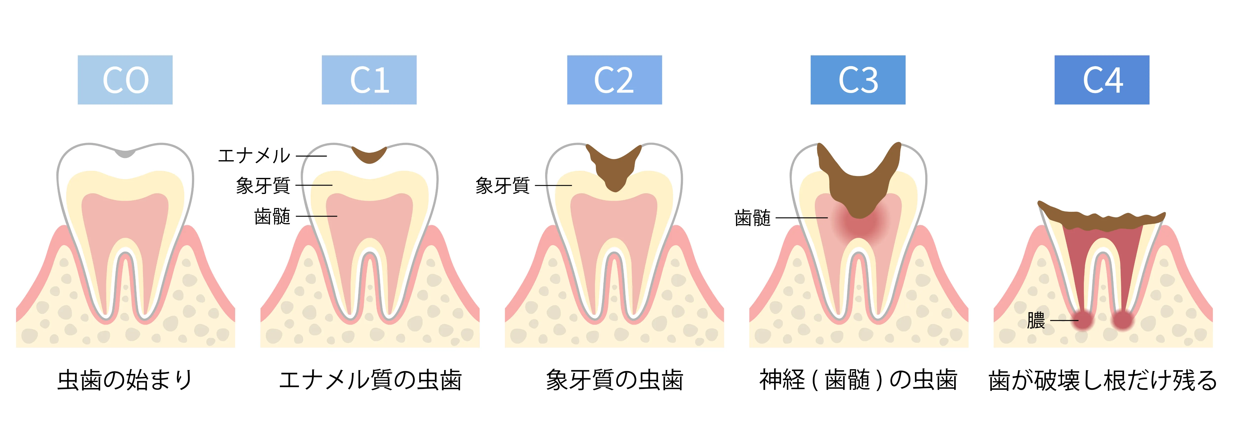 虫歯の進行段階を示す歯の断面イメージ
